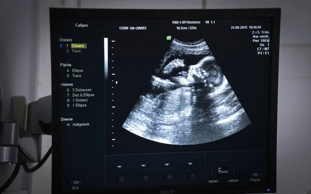 A medical monitor displays an obstetric ultrasound scan of a fetus.